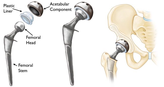 Total-Hip-Replacement