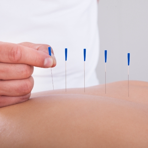 Dry-needling-Telma-Grant-Physio-&-Sports-Therapy-Bowmanville-ON